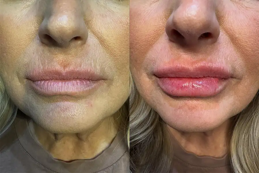 Before and after front-view comparison of lip filler results at The Ivy Collective in Pawnee, IL, showing noticeably fuller lips after treatment.